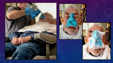 photo of facial impressions for a nasal prosthesis