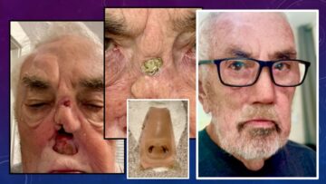series of photos summarizing man's maxillofacial prosthetic treatment success