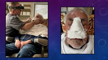 photo of facial impression procedure