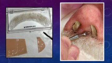 photos showing addition of a moustache into a nasal prosthesis