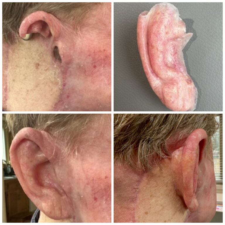 photos of partially amputated ear, the ear prosthesis by itself and the prosthesis glued in place