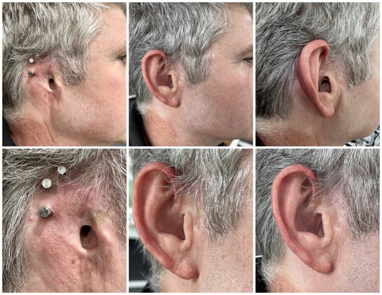 Photo series of Osseointegration and magnetic retention of ear prosthesis