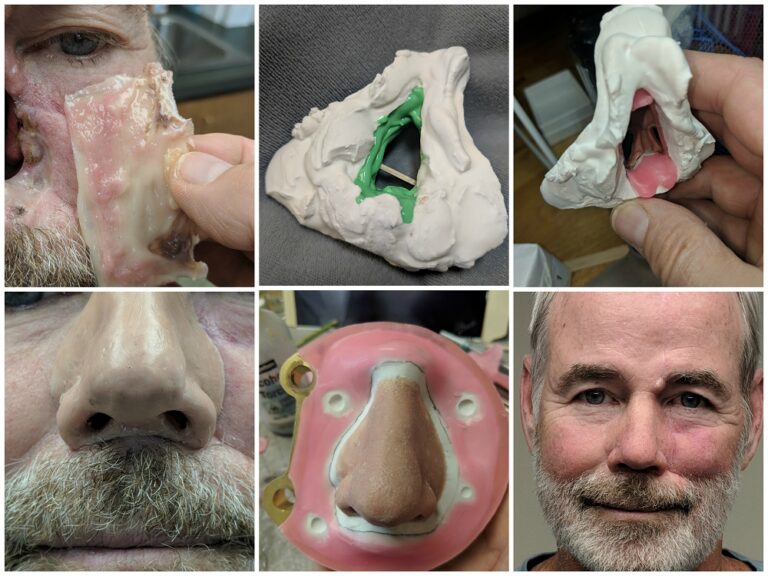 series of photos showing nasal prosthesis creation