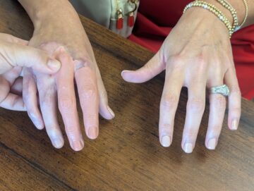 Wax fingers as prototypes for prosthetic fingers